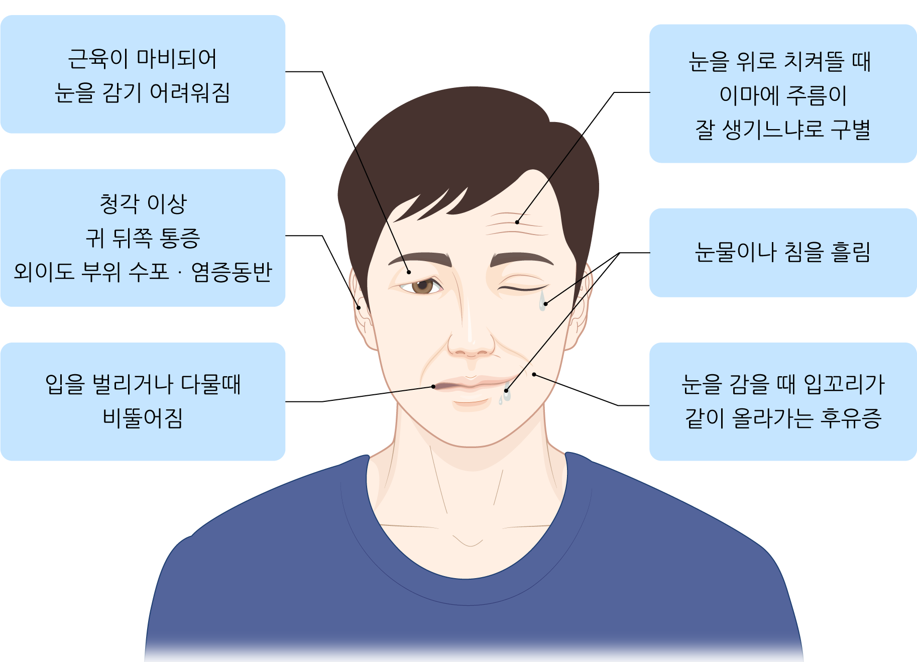 구안와사